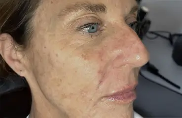 Evolysse™ – After | Ciao Bella Aesthetics