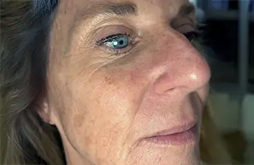 Evolysse™ – Before | Ciao Bella Aesthetics
