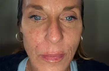 Evolysse™ – After | Ciao Bella Aesthetics