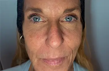 Evolysse™ – Before | Ciao Bella Aesthetics