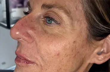 Evolysse™ – After | Ciao Bella Aesthetics