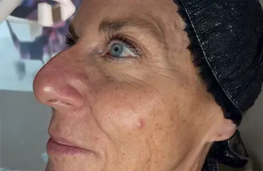 Evolysse™ – Before | Ciao Bella Aesthetics