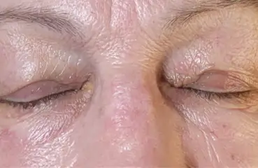 Fibroblast Lift – After | Ciao Bella Aesthetics