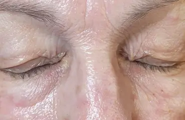 Fibroblast Lift – Before | Ciao Bella Aesthetics