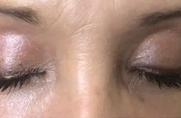 Fibroblast Lift – After | Ciao Bella Aesthetics