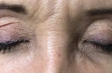 Fibroblast Lift – Before | Ciao Bella Aesthetics