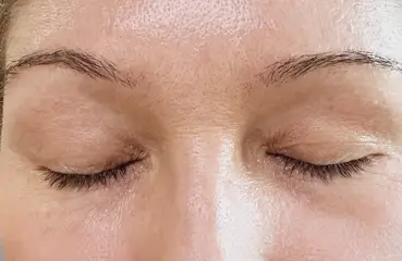 Fibroblast Lift – After | Ciao Bella Aesthetics