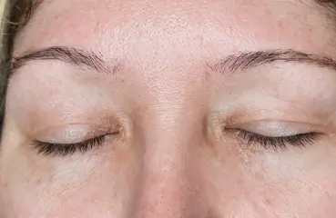 Fibroblast Lift – Before | Ciao Bella Aesthetics
