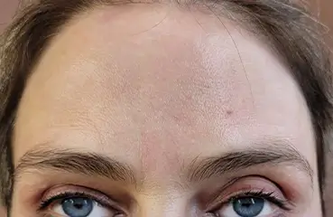 Fibroblast Lift – After | Ciao Bella Aesthetics