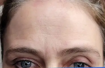 Fibroblast Lift – Before | Ciao Bella Aesthetics