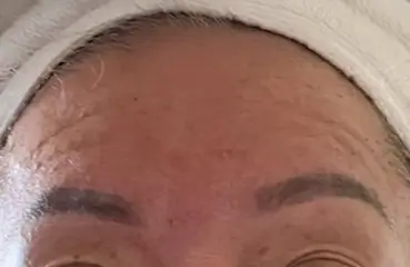 Fibroblast Lift – After | Ciao Bella Aesthetics
