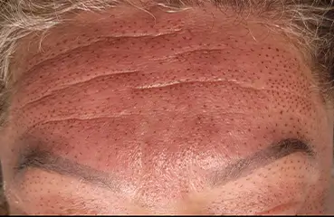 Fibroblast Lift – Before | Ciao Bella Aesthetics