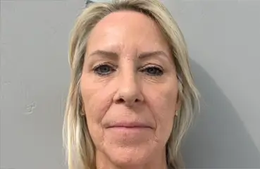 Fibroblast Lift – After | Ciao Bella Aesthetics