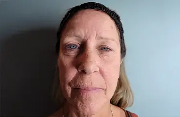 Fibroblast Lift – Before | Ciao Bella Aesthetics