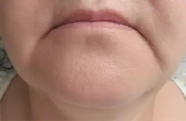 Fibroblast Lift – After | Ciao Bella Aesthetics