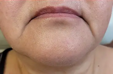 Fibroblast Lift – Before | Ciao Bella Aesthetics