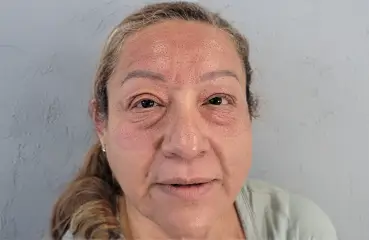 Fibroblast Lift – After | Ciao Bella Aesthetics