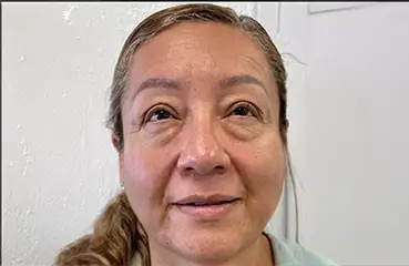 Fibroblast Lift – Before | Ciao Bella Aesthetics