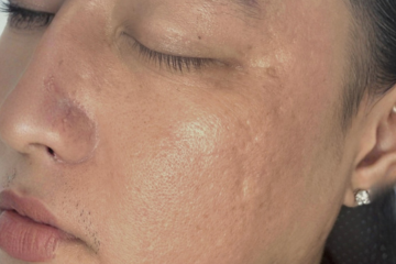 RF Microneedling 1 - before (2)
