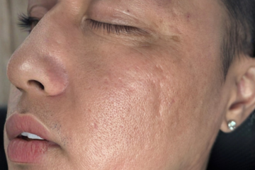 RF Microneedling 1 - before