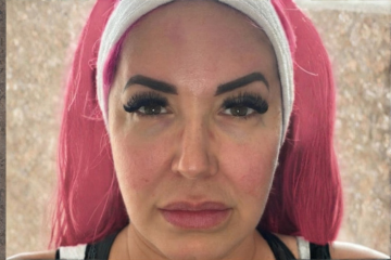RF Microneedling 2 - after