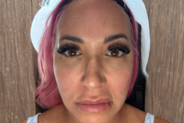 RF Microneedling 2 - before