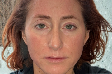 RF Microneedling 3 - after