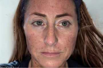 RF Microneedling 3 - before