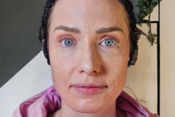 RF Microneedling 4 - after
