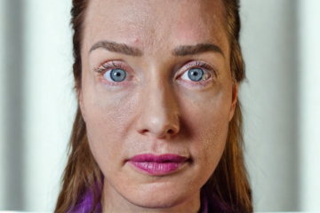 RF Microneedling 4 - before