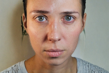 RF Microneedling 5 - after