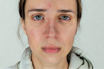RF Microneedling 5 - before
