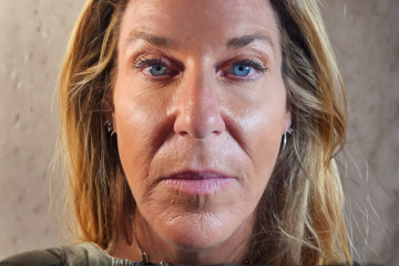 RF Microneedling 6 - after