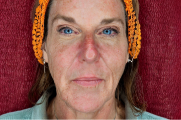 RF Microneedling 6 - before