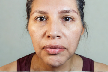 RF Microneedling 7 - after