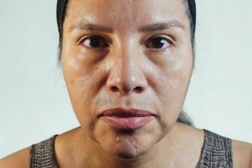 RF Microneedling 7 - before
