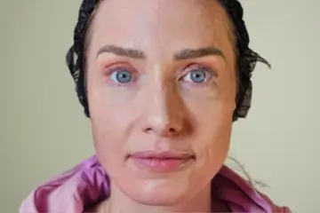 cba-rf-microneedling-after-2