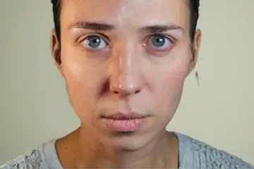 cba-rf-microneedling-after-3