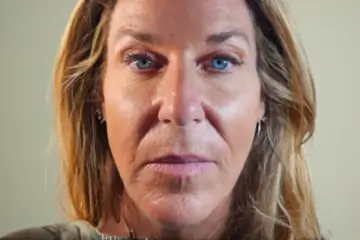 cba-rf-microneedling-after-4