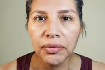 cba-rf-microneedling-after-5