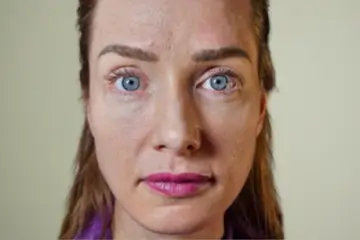 cba-rf-microneedling-before-2