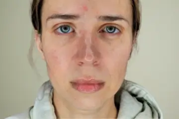 cba-rf-microneedling-before-3