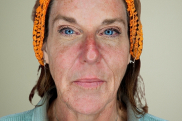 cba-rf-microneedling-before-4