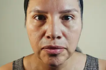 cba-rf-microneedling-before-5